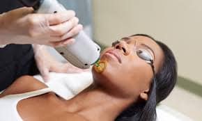 laser hair removal